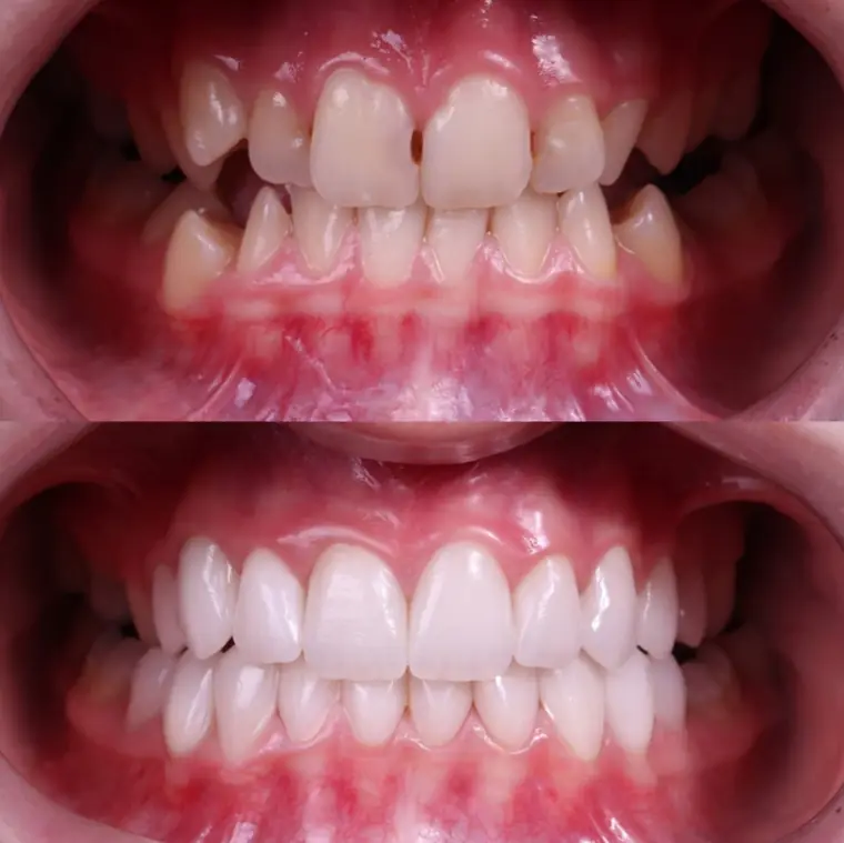 Porcelain veneer before and after — Case 01, real patient of Dr. Edward Nam at ID Dental Koreatown