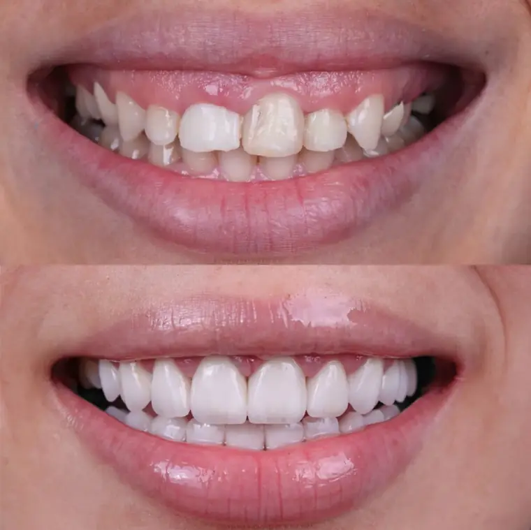 Porcelain veneer before and after — Case 02, real patient of Dr. Edward Nam at ID Dental Koreatown