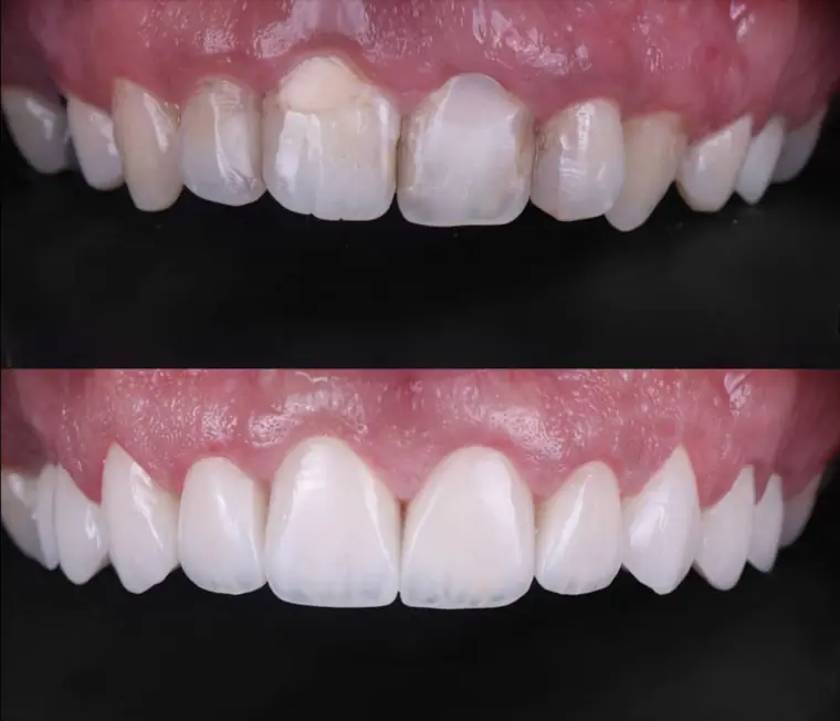 Porcelain veneer before and after — Case 03, real patient of Dr. Edward Nam at ID Dental Koreatown