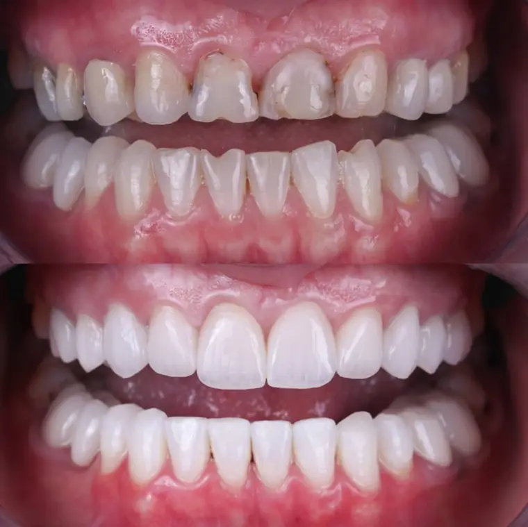 Porcelain veneer before and after — Case 04, real patient of Dr. Edward Nam at ID Dental Koreatown