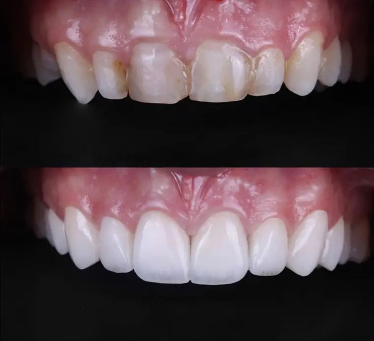 Porcelain veneer before and after — Case 05, real patient of Dr. Edward Nam at ID Dental Koreatown