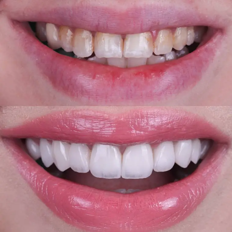 Porcelain veneer before and after — Case 06, real patient of Dr. Edward Nam at ID Dental Koreatown