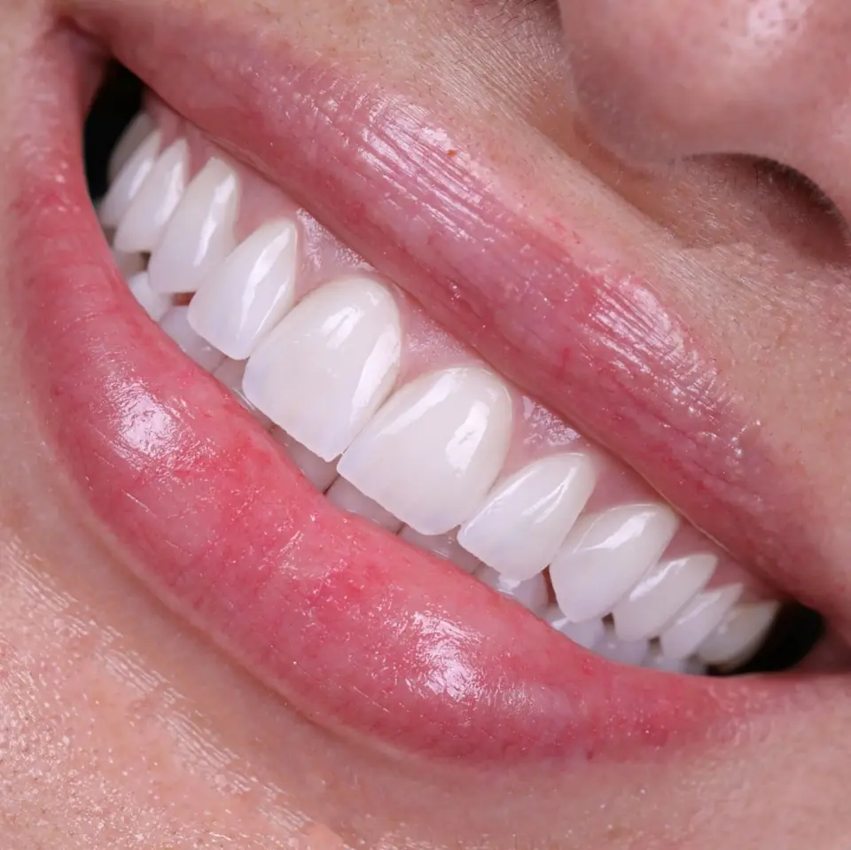 Porcelain veneer smile by Dr. Edward Nam — aesthetic dentistry at ID Dental